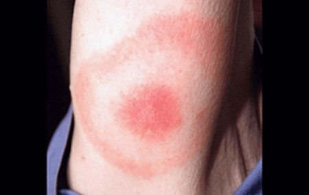 Bull’s eye rash