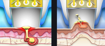 Acne-treatment