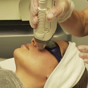 Who Would Be the Perfect Candidate for Laser Skin Resurfacing?