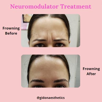 Neuromodulator Treatment