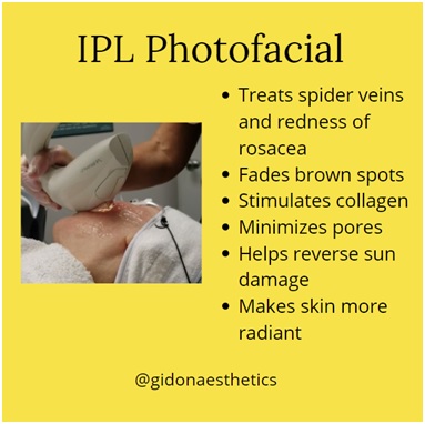 IPL Photofacial